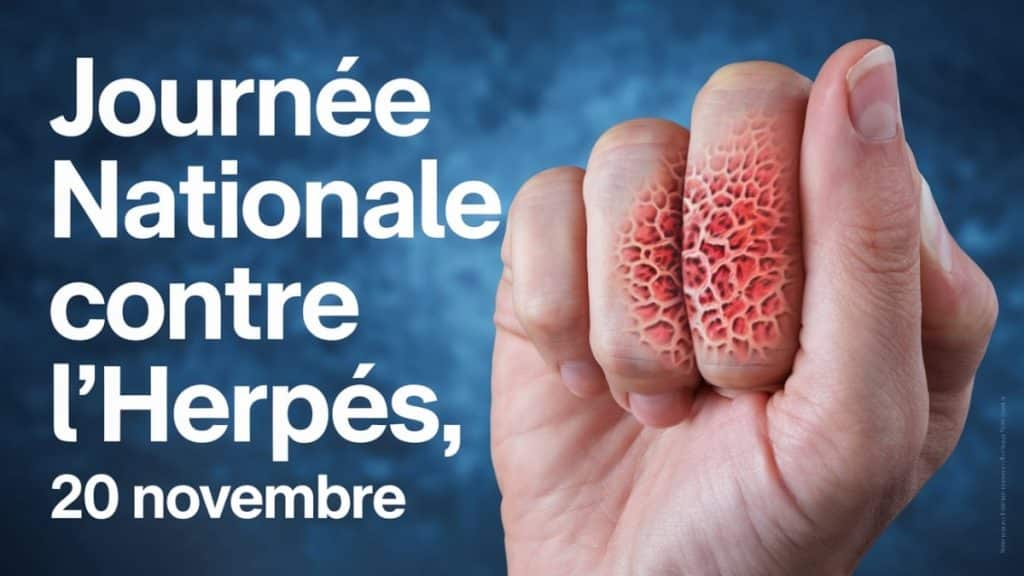 Campagne contre l'herpès